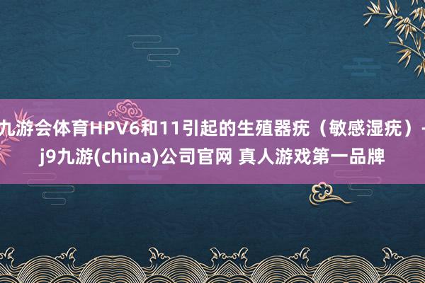 九游会体育HPV6和11引起的生殖器疣（敏感湿疣）-j9九游(china)公司官网 真人游戏第一品牌